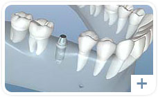 dental implants graphic