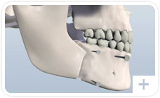 jaw surgery graphic